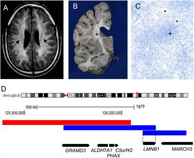 Autosomal Dominant Leukodystrophy: A Disease of the Nuclear Lamina